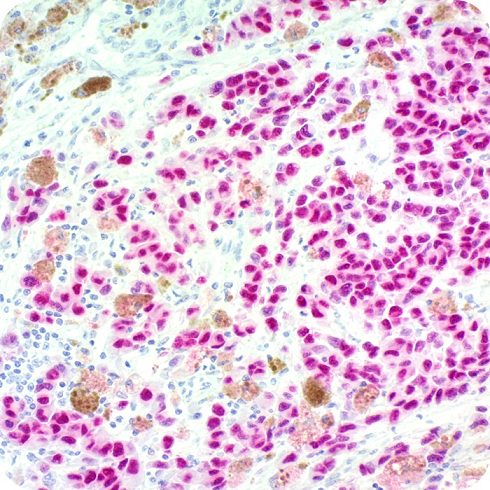 SOX10 (Melanoma Marker); Clone SOX10/991 (Concentrate)